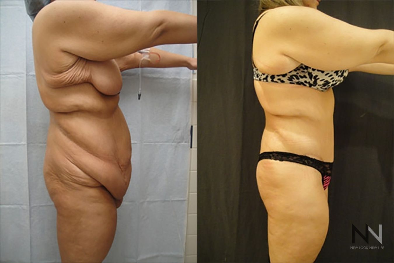 Abdominoplasty before and after showing flatter abdomen - Angle 3