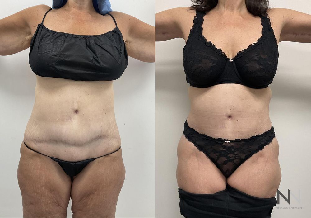 Tummy Tuck - Thumbnail 3