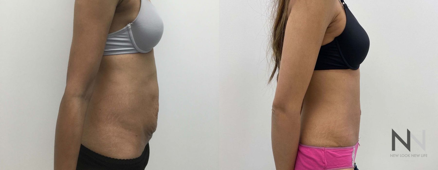 Tummy Tuck - Thumbnail 3