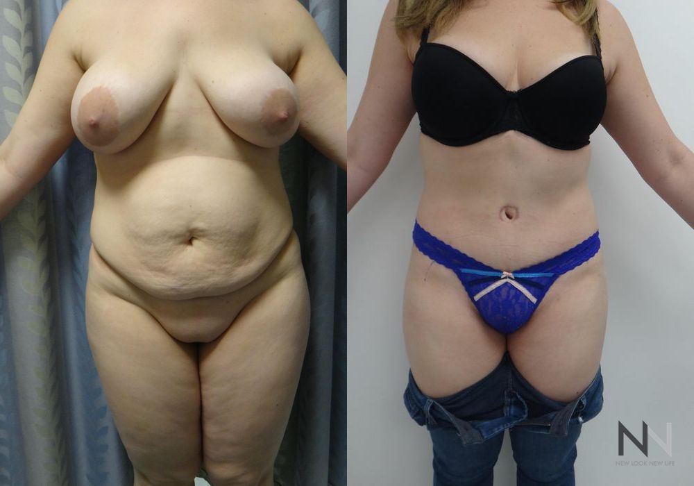 Tummy Tuck - Case 1924