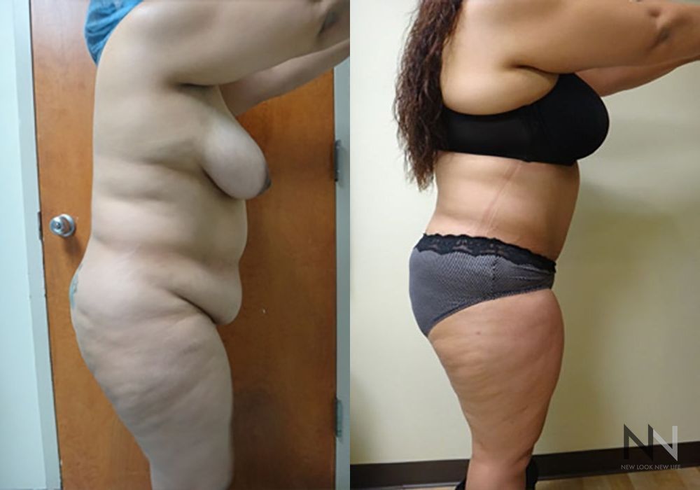 Tummy Tuck - Thumbnail 3