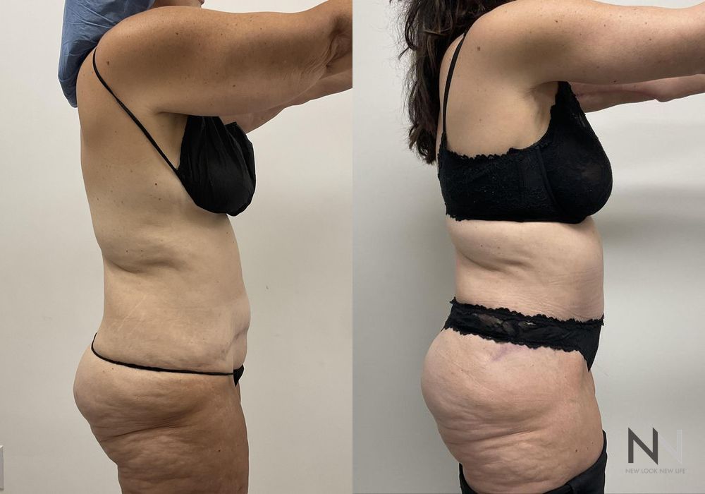 Tummy Tuck - Thumbnail 2