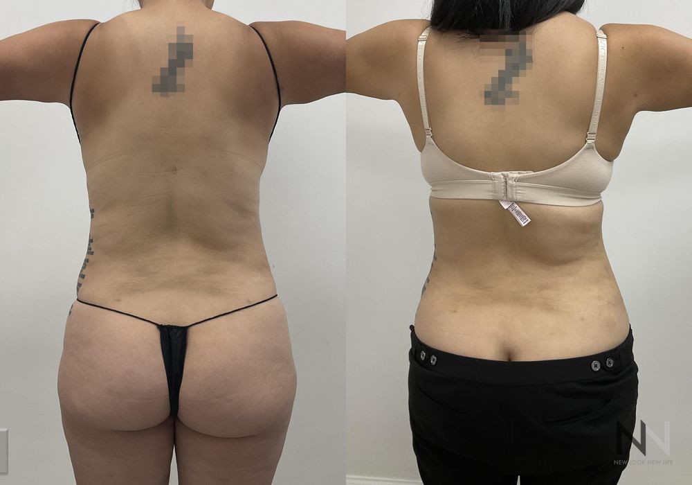 Tummy Tuck - Thumbnail 4