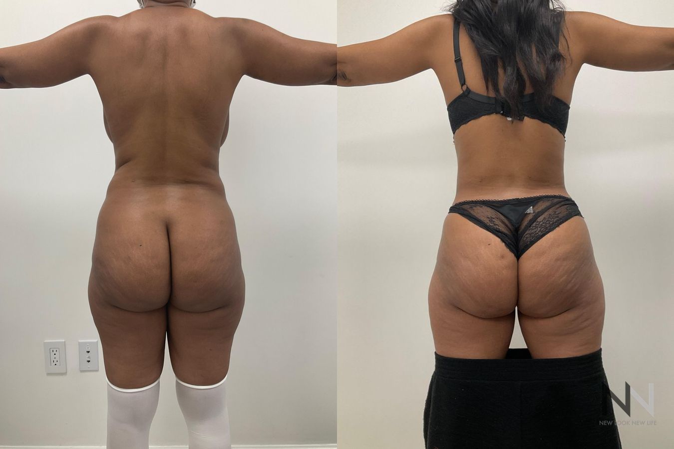 Abdominoplasty and liposuction showing improved contour - Angle 2