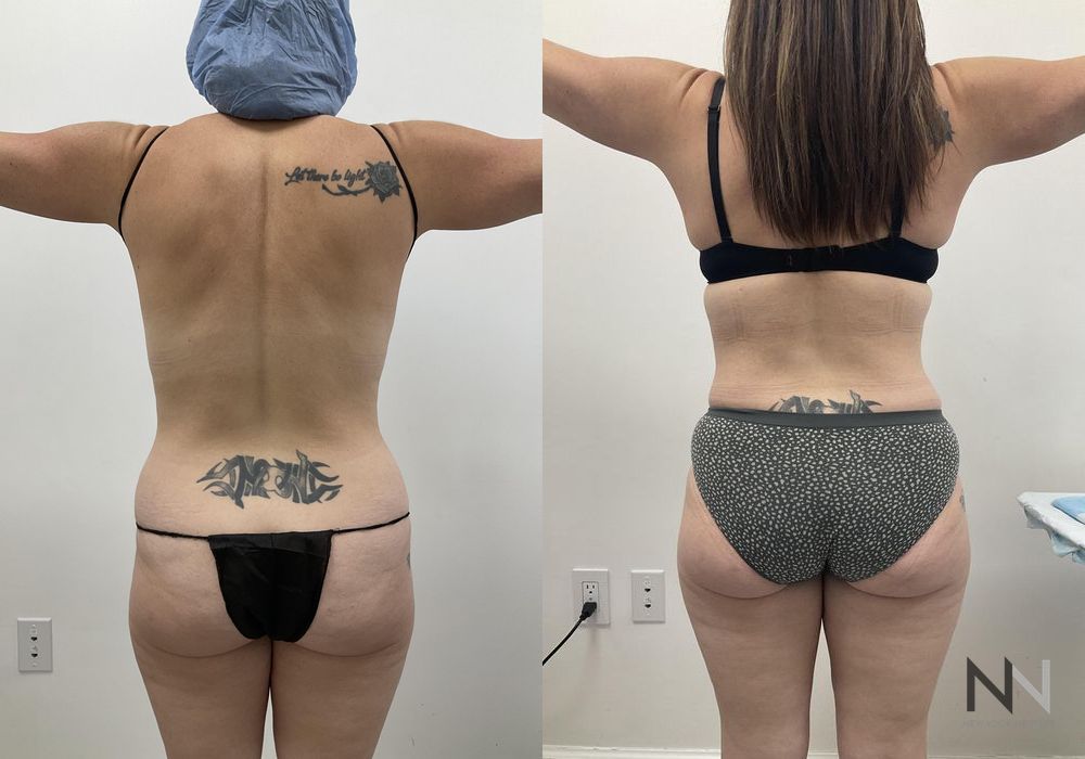 Tummy Tuck - Thumbnail 3