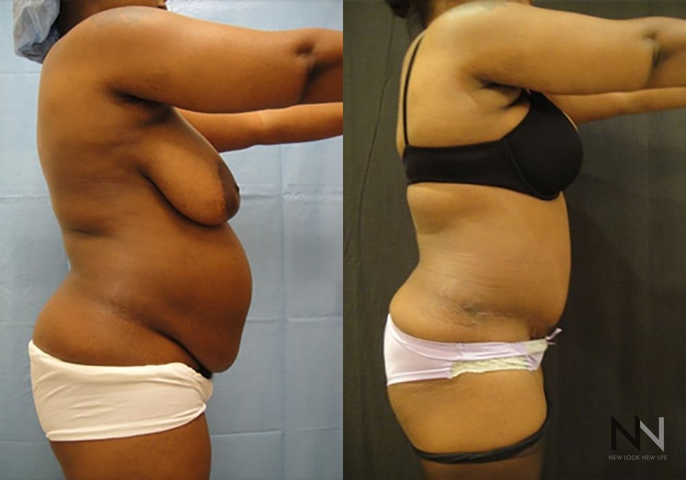 Tummy Tuck - Thumbnail 3