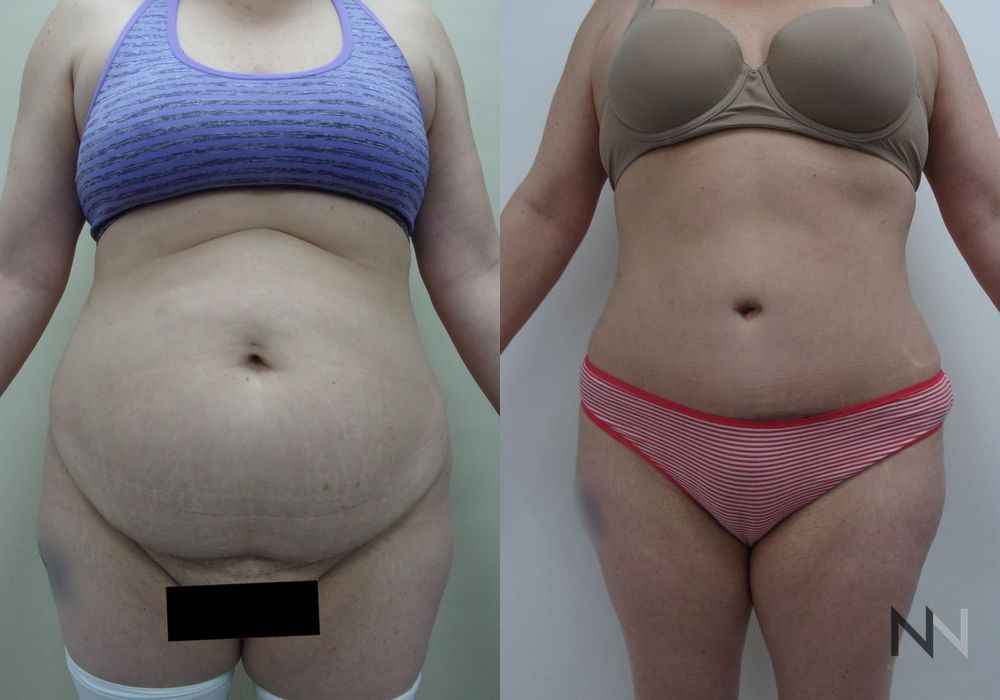 Tummy Tuck - Case 2113