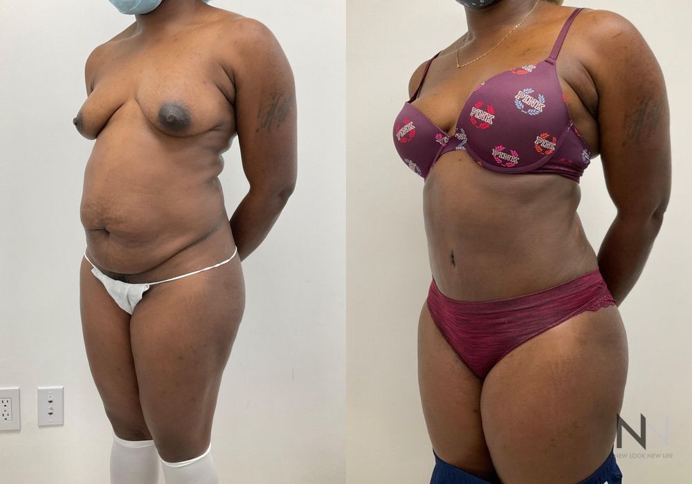 Before and after Tummy Tuck case 21027 - Angle 2