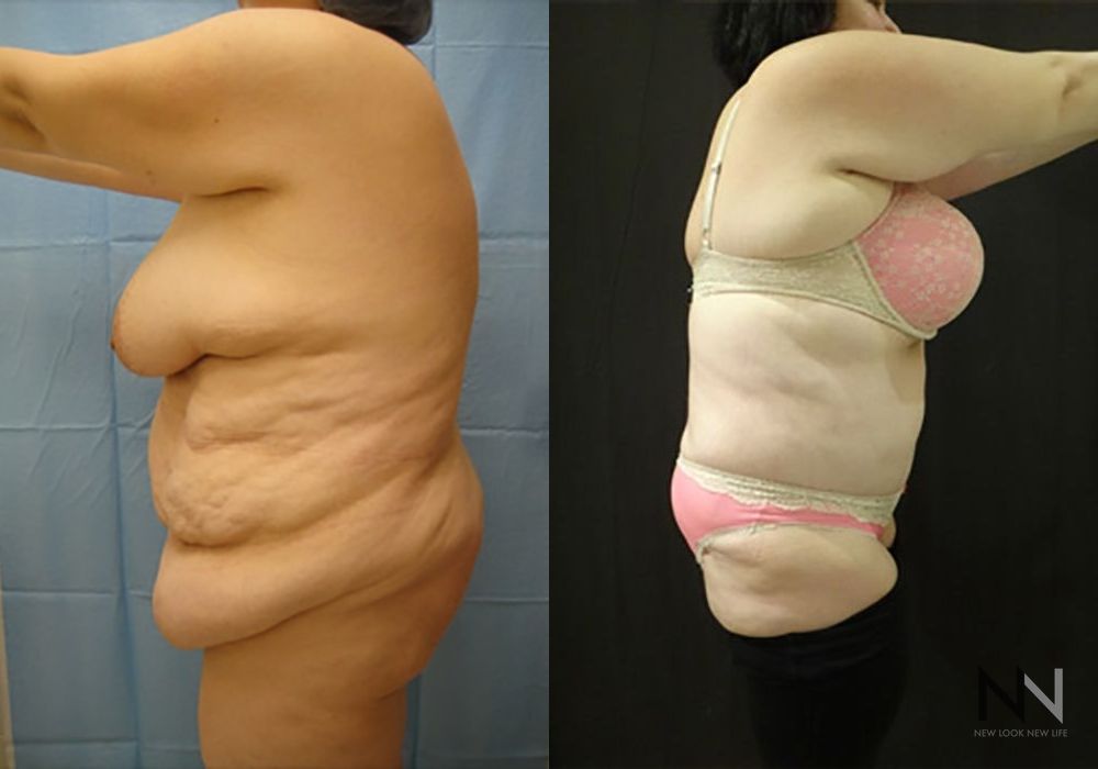 Tummy Tuck - Thumbnail 2