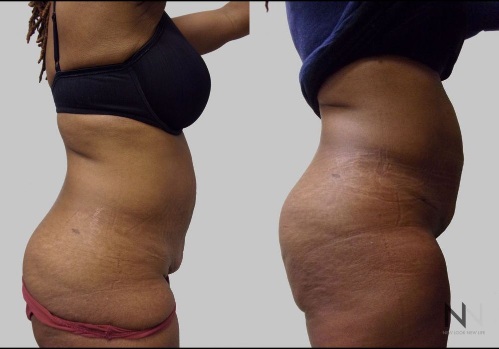 Tummy Tuck - Thumbnail 3