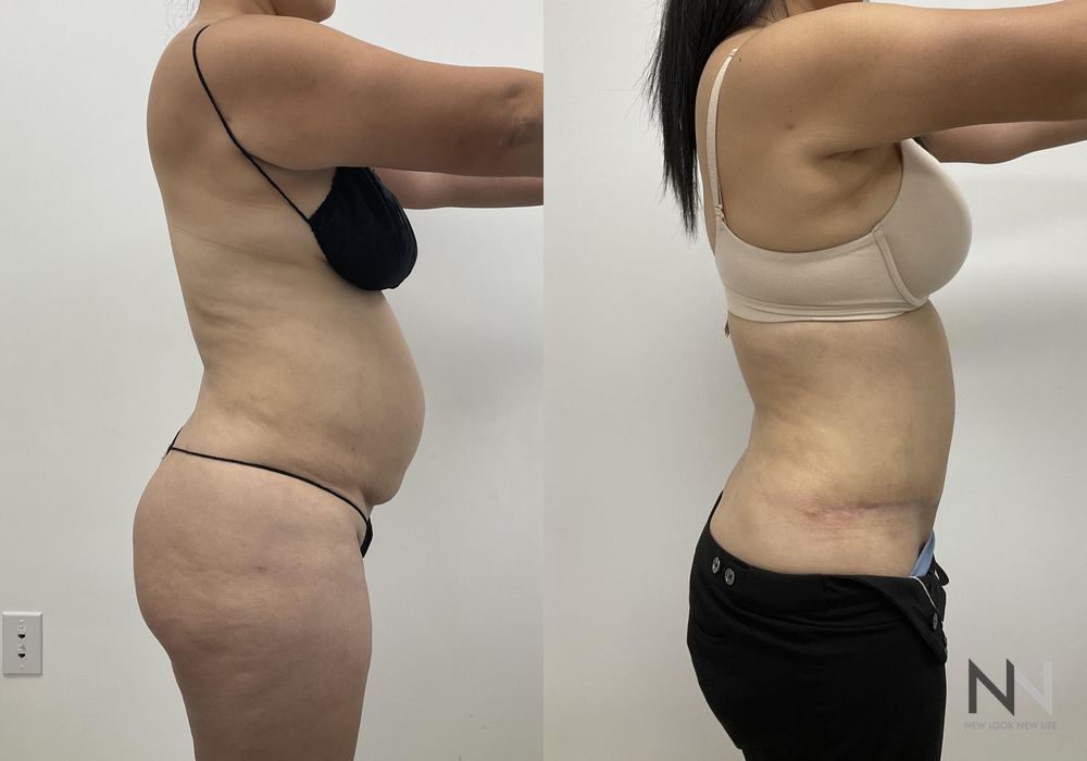 Tummy Tuck - Thumbnail 2