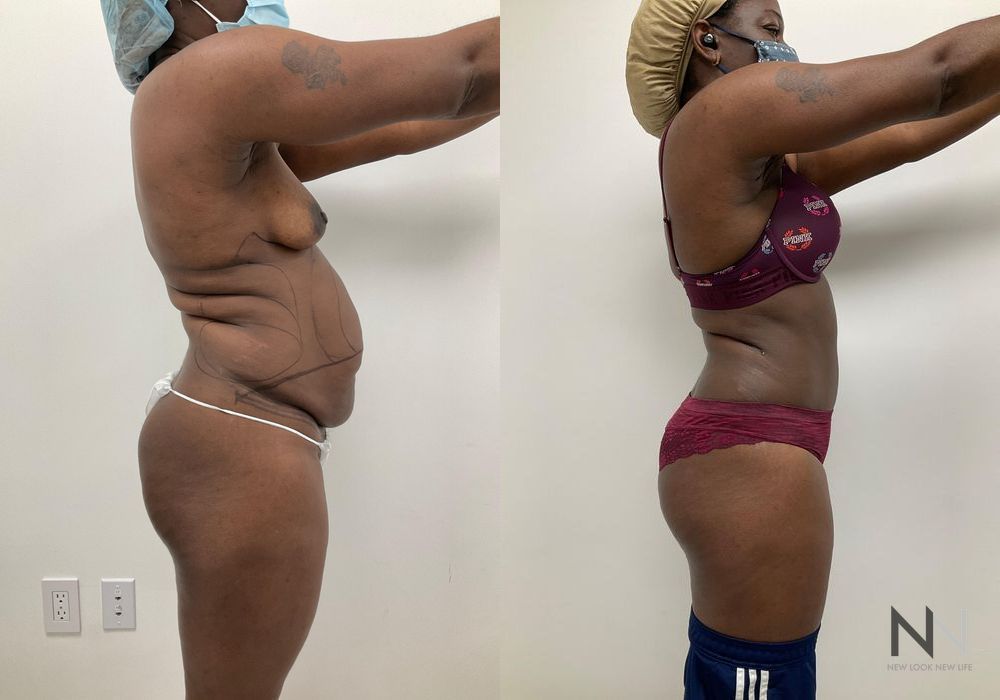 Tummy Tuck - Thumbnail 3