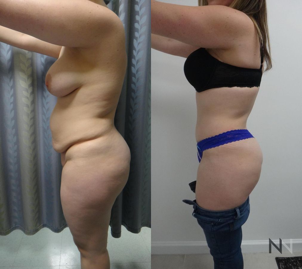 Midsection contour refinement after abdominoplasty - Angle 2