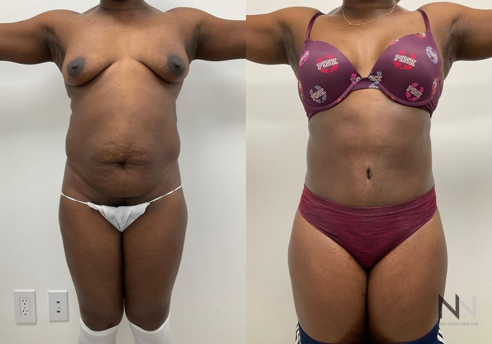 Before and after Tummy Tuck case 21027