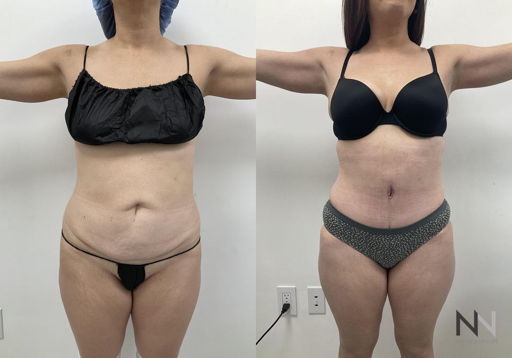 Tummy Tuck - Thumbnail 2