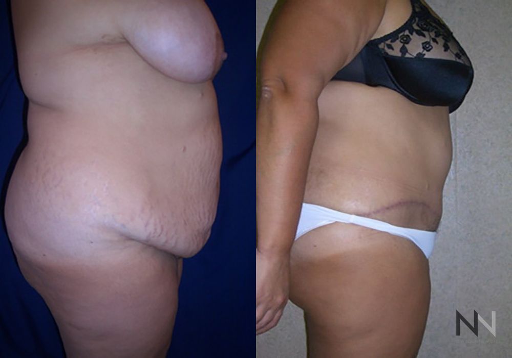 Tummy Tuck - Thumbnail 3