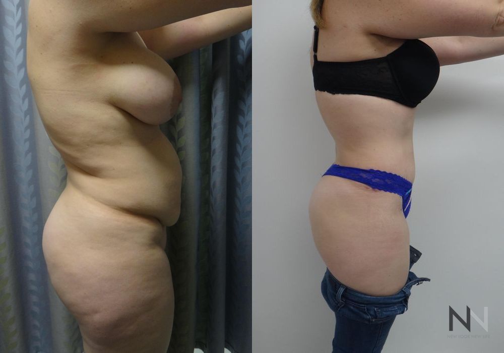 Tummy Tuck - Thumbnail 3