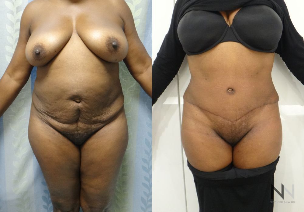 Tummy Tuck - Case 1904