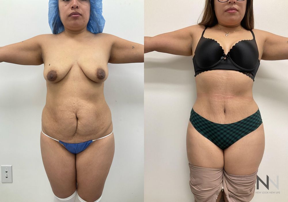 Tummy Tuck - Case 1902