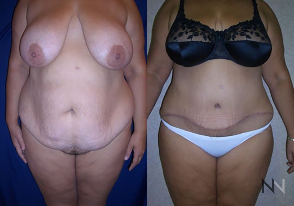 Tummy Tuck - Case 1909