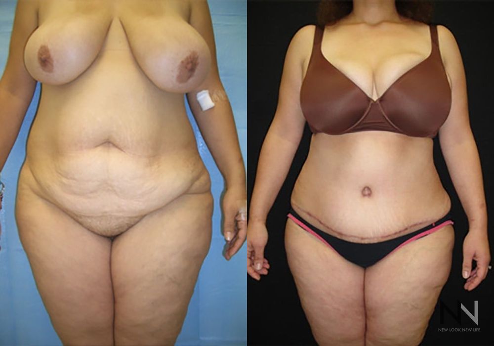 Tummy Tuck - Case 1920