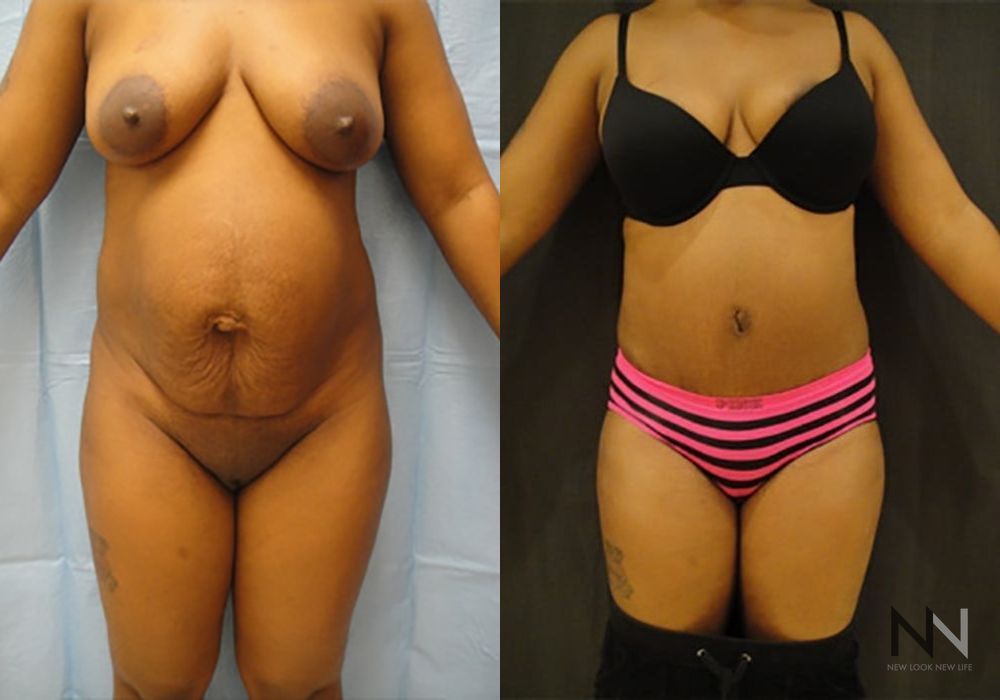 Tummy Tuck - Case 2103