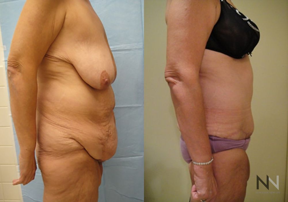 Tummy Tuck - Thumbnail 3