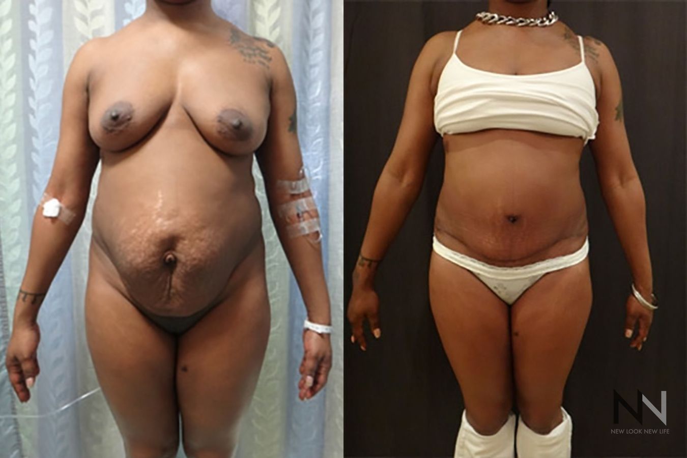 Tummy tuck before and after abdominal contour improvement