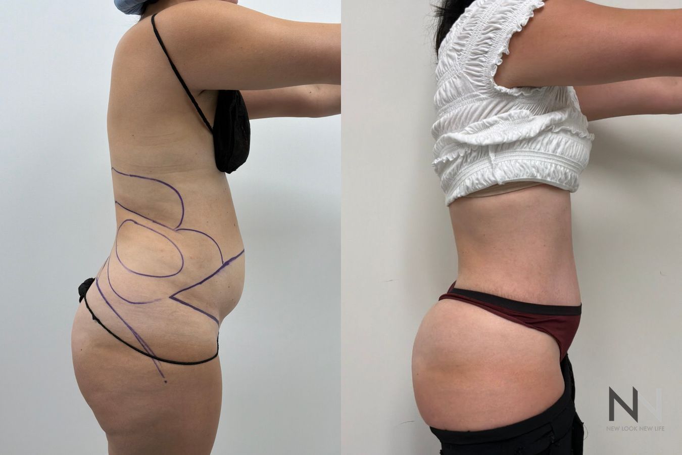 Abdominoplasty before and after showing improved abdominal contour and removal of excess skin by Dr. Claudia Kim in NYC. - Angle 2