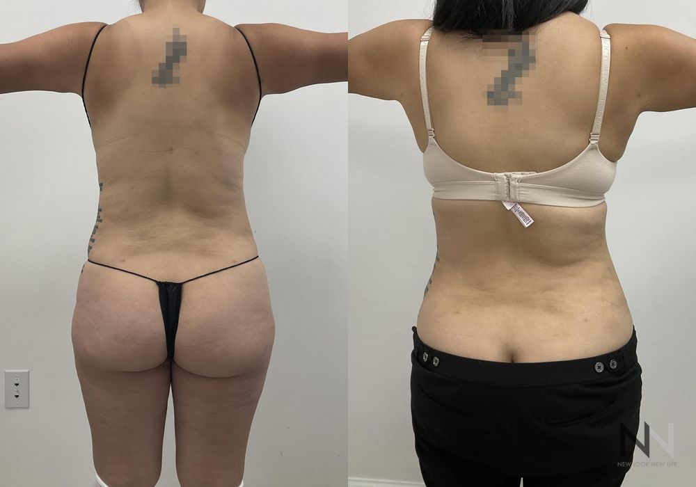 Tummy Tuck - Thumbnail 4