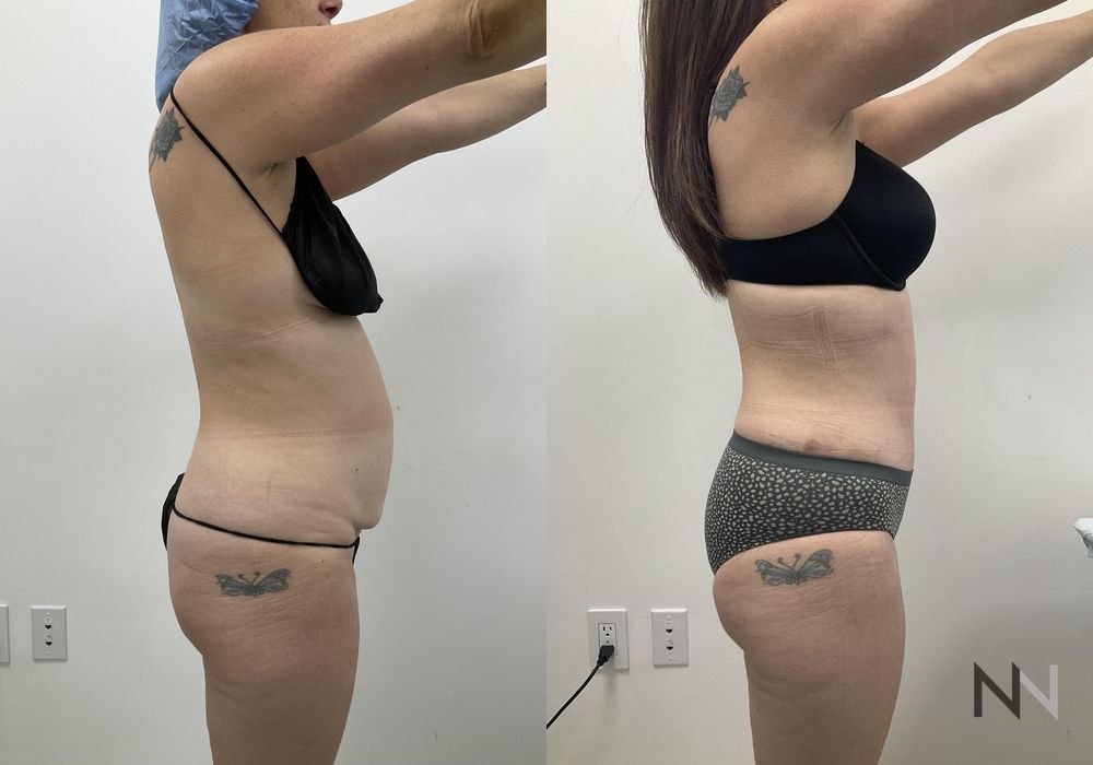 Tummy Tuck - Thumbnail 4