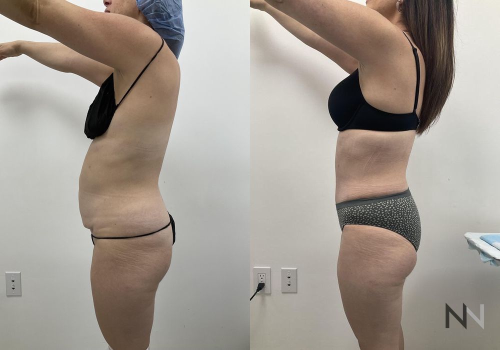 Tummy Tuck - Case 1930