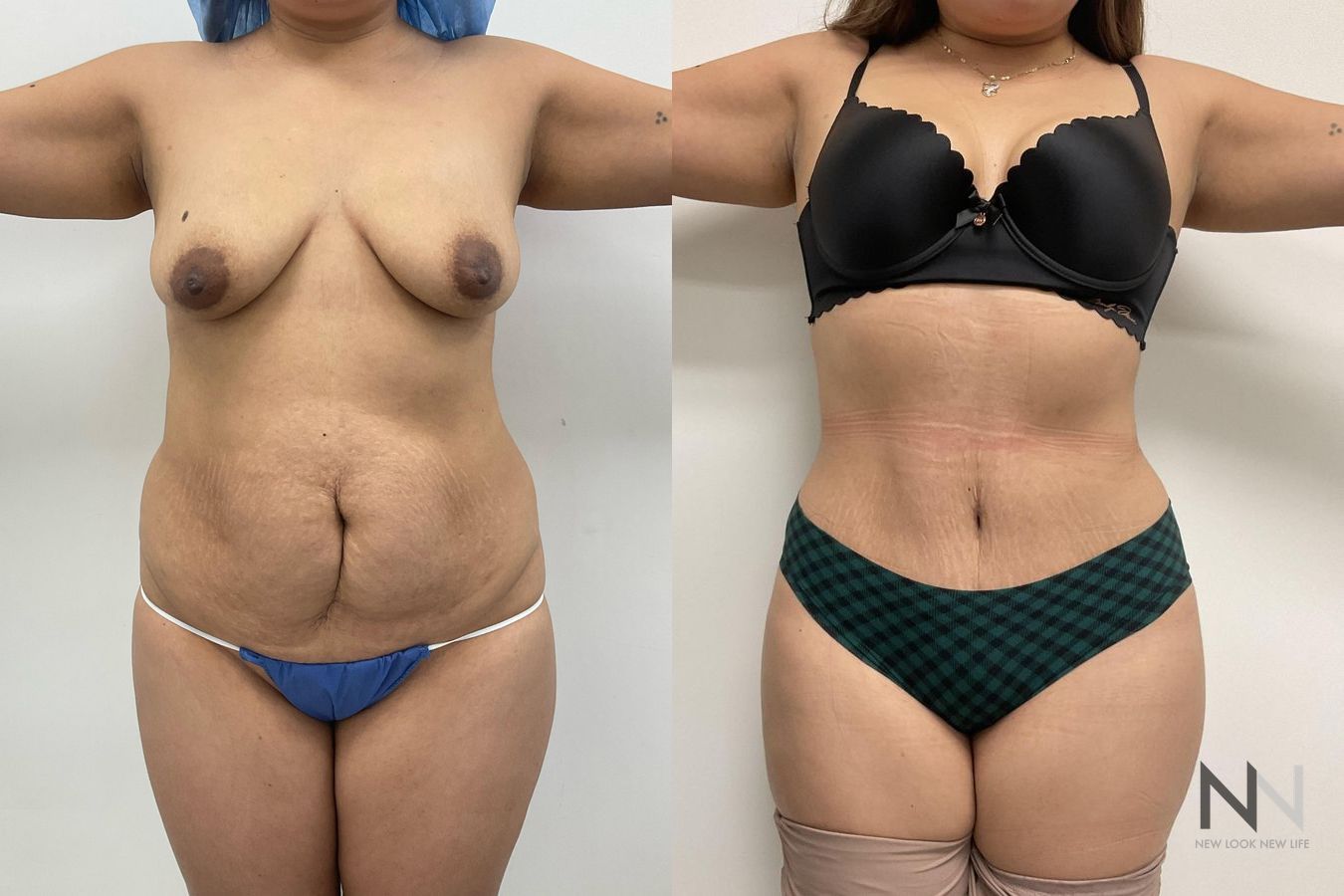 Before and after tummy tuck with flank liposuction