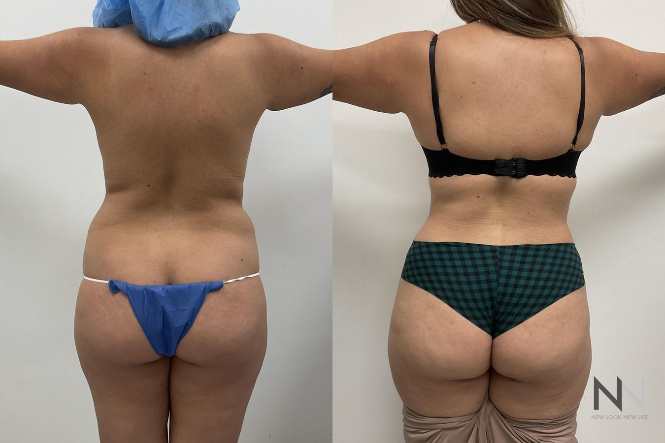 Before and after tummy tuck with flank liposuction - Angle 4