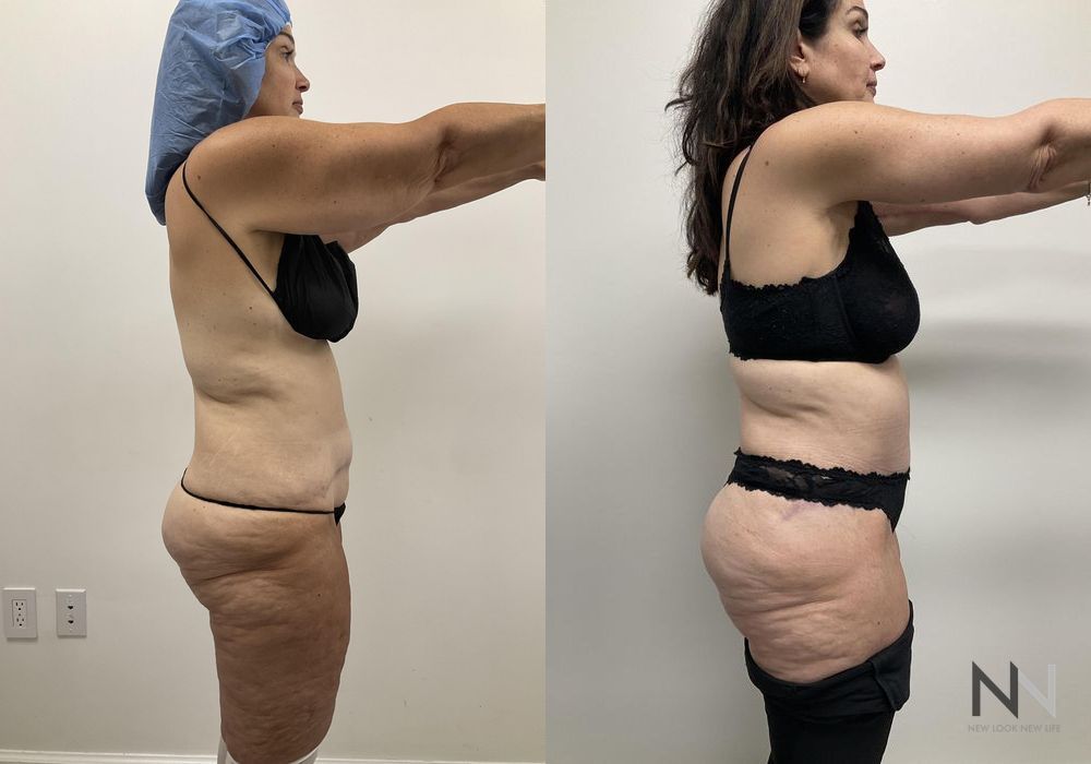 Tummy Tuck - Thumbnail 2