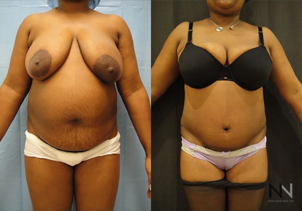 Tummy Tuck - Case 2110