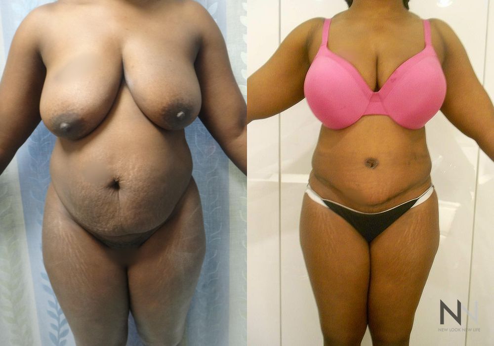 Tummy Tuck - Case 2118