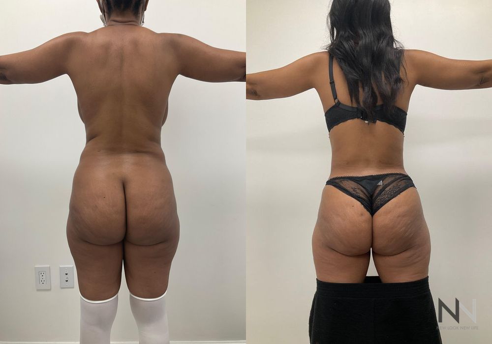 Tummy Tuck - Thumbnail 2