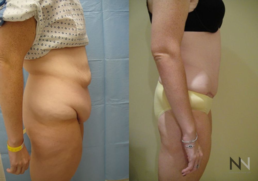 Tummy Tuck - Thumbnail 3