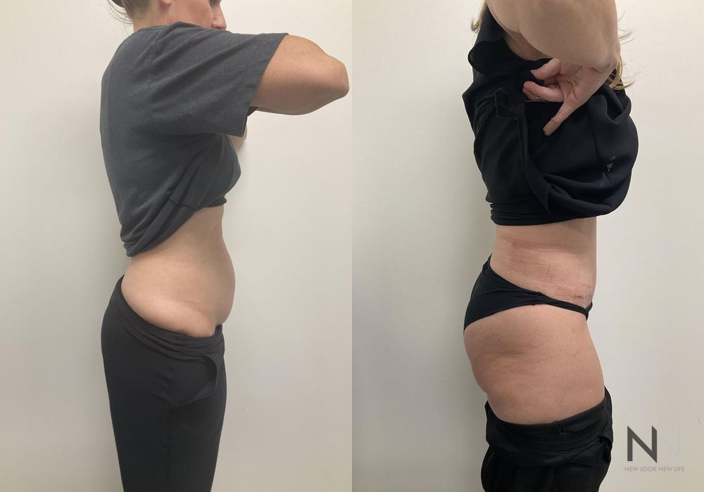 Tummy Tuck - Thumbnail 4