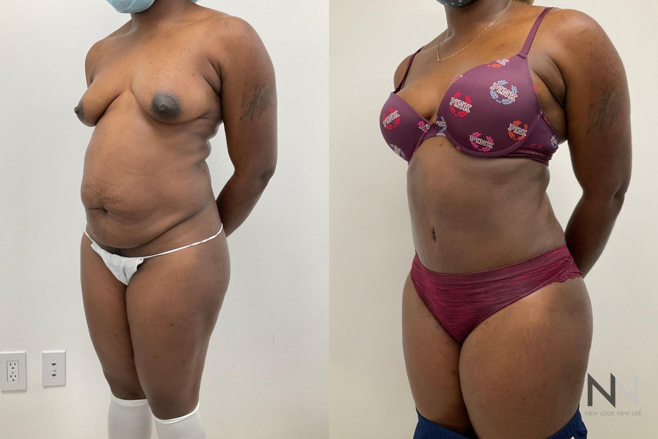 Before and after tummy tuck with liposuction six months - Angle 2