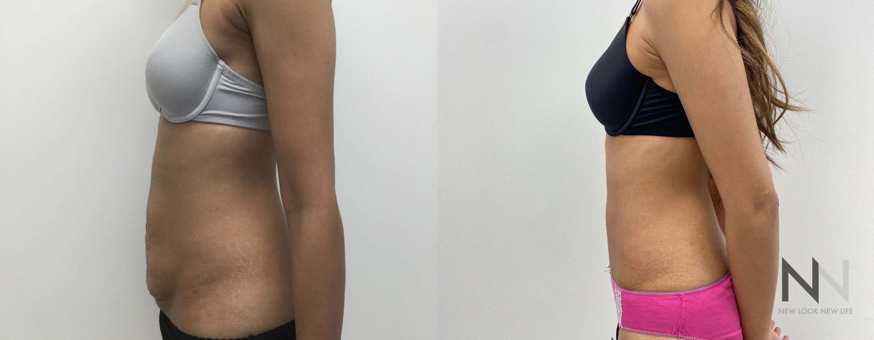 Tummy Tuck - Case 2095