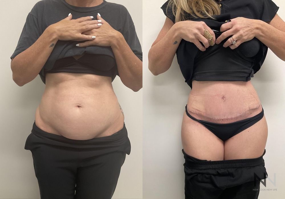 Tummy Tuck - Case 2120