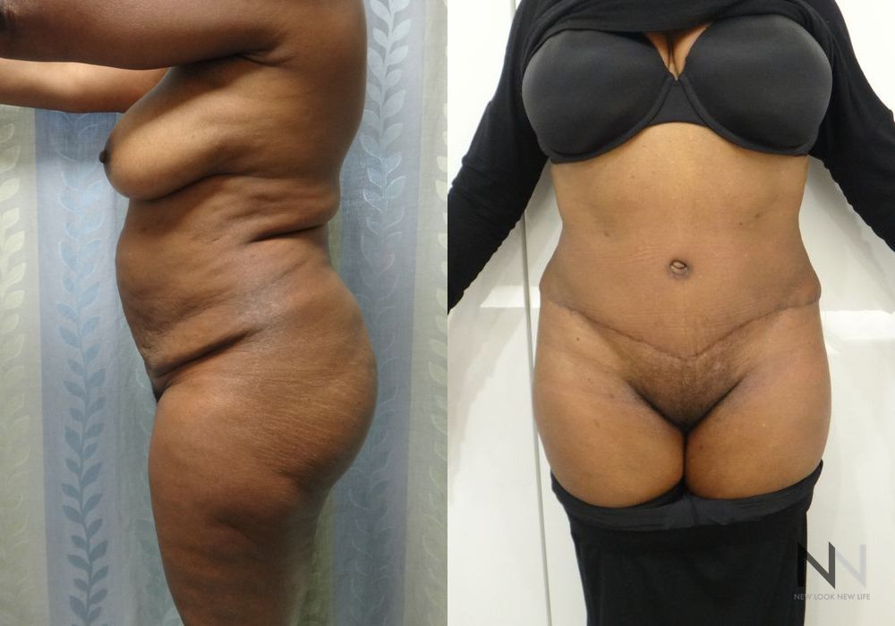 Tummy Tuck - Thumbnail 2