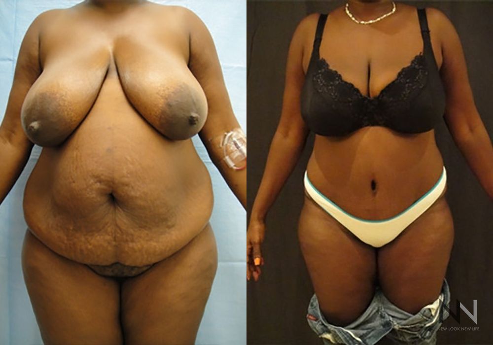 Tummy Tuck - Case 2104