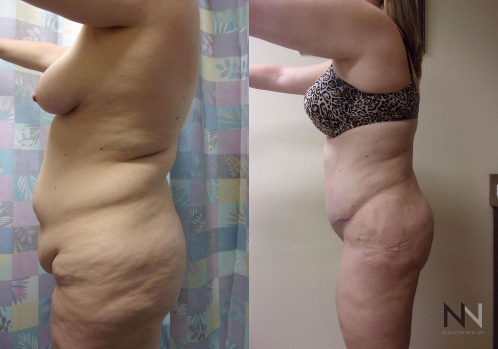 Tummy Tuck - Thumbnail 2