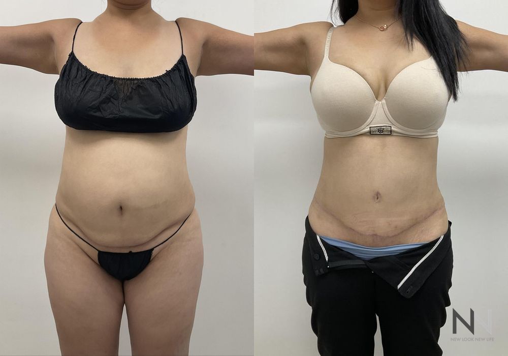 Tummy Tuck - Thumbnail 3