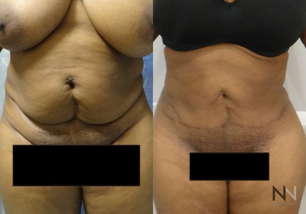 Tummy Tuck - Case 1935