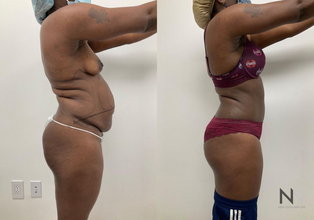 Before and after Tummy Tuck case 21027 - Angle 3