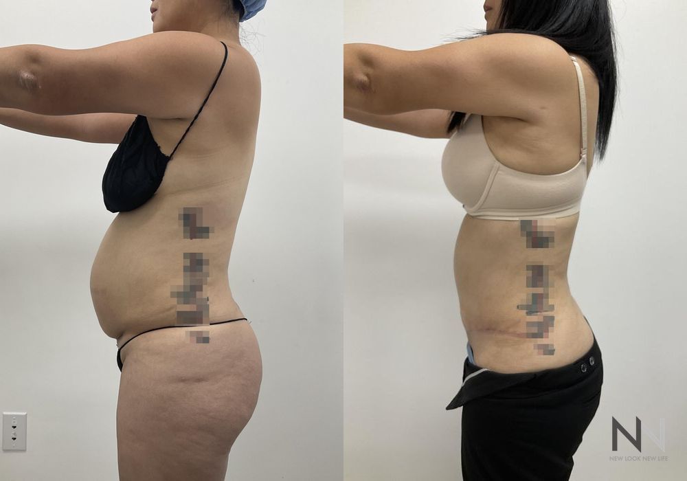 Tummy Tuck - Thumbnail 2